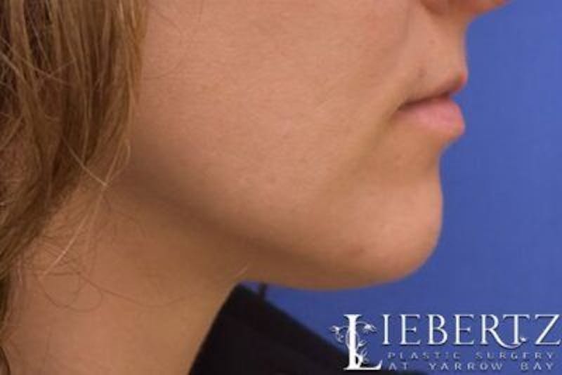 Chin Augmentation Before & After Gallery - Patient 163940 - Image 4