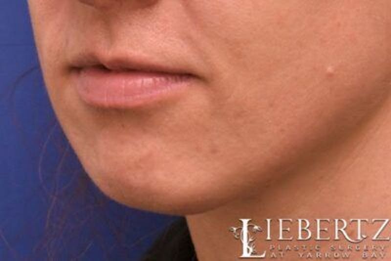 Chin Augmentation Before & After Gallery - Patient 163940 - Image 5
