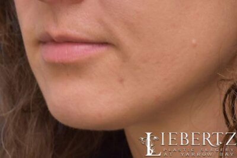 Chin Augmentation Before & After Gallery - Patient 163940 - Image 6