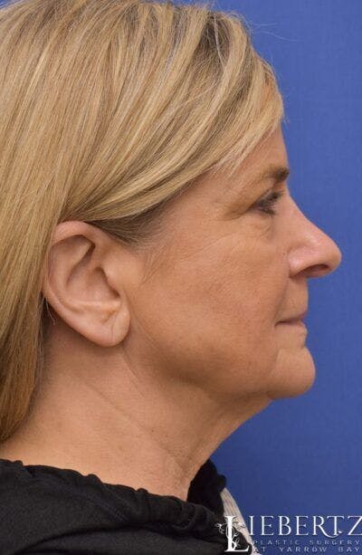 Necklift Before & After Gallery - Patient 284135 - Image 1