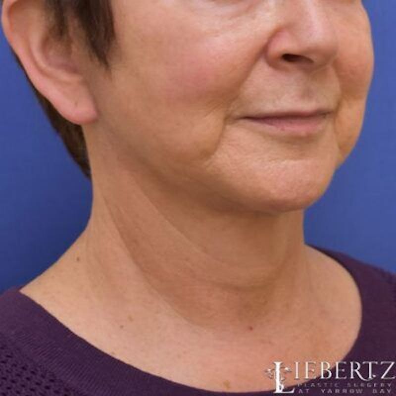 Necklift Before & After Gallery - Patient 672132 - Image 2