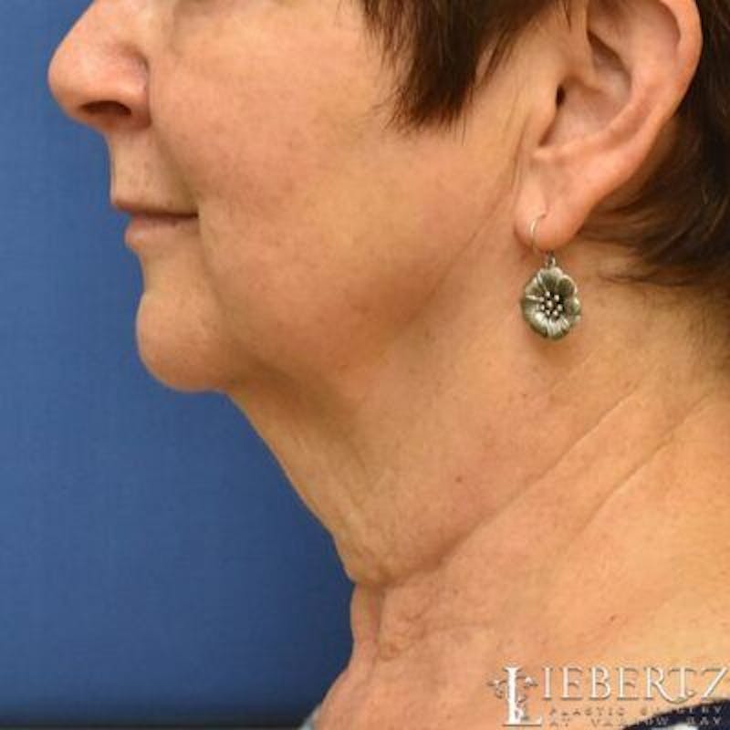Necklift Before & After Gallery - Patient 672132 - Image 3