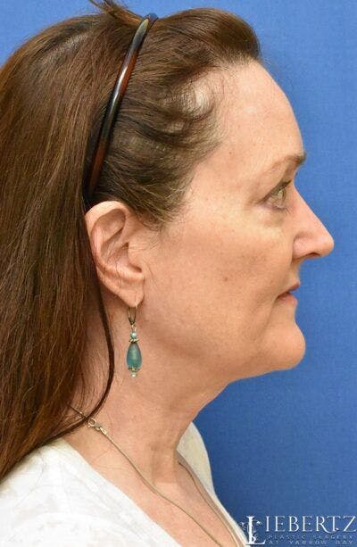 Necklift Before & After Gallery - Patient 158368 - Image 1