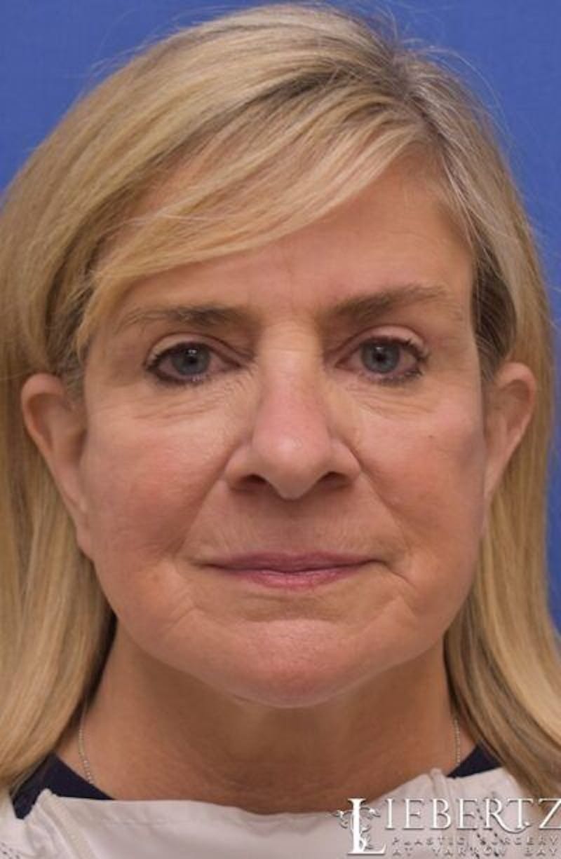 Facelift Before & After Gallery - Patient 331654 - Image 2