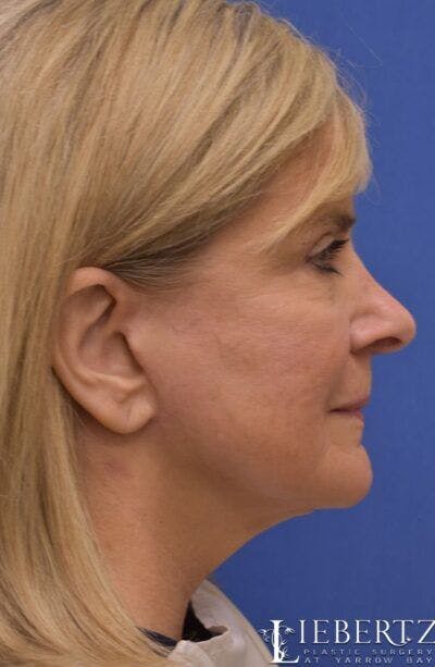 Facelift Before & After Gallery - Patient 331654 - Image 2