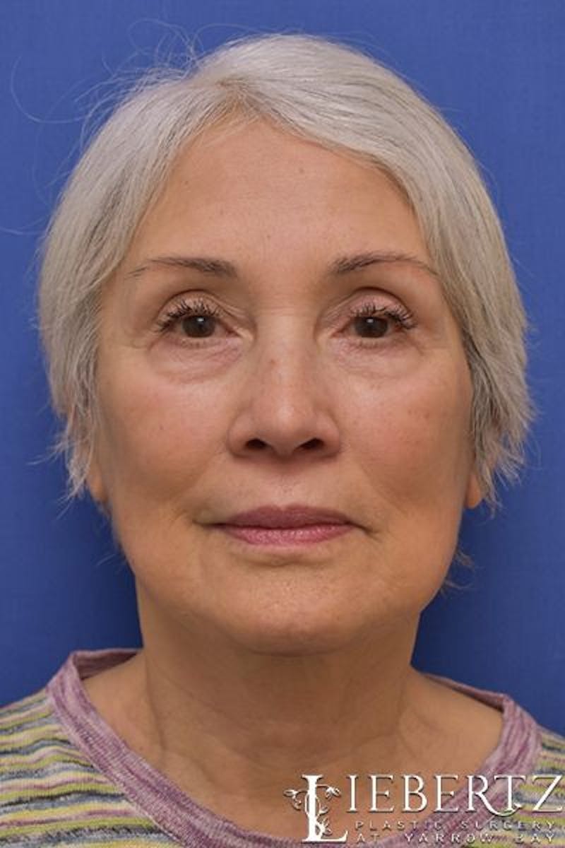 Necklift Before & After Gallery - Patient 263590 - Image 2