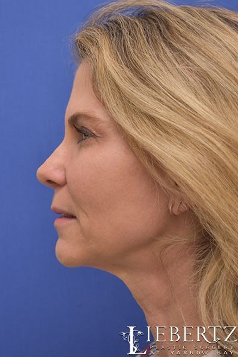 Blepharoplasty Before & After Gallery - Patient 417331 - Image 5