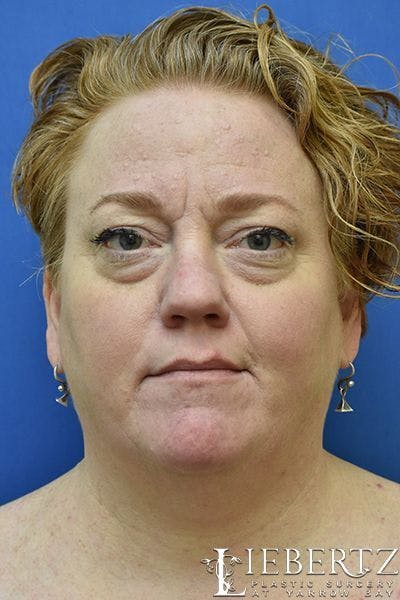Non-Surgical Lower Blepharoplasty Before & After Gallery - Patient 185610 - Image 1