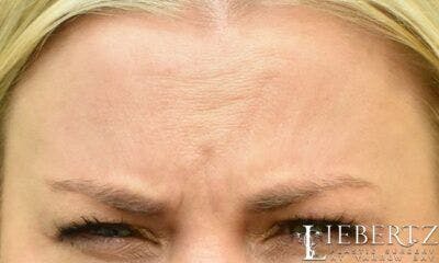 Wrinkle Relaxers Before & After Gallery - Patient 195268 - Image 1