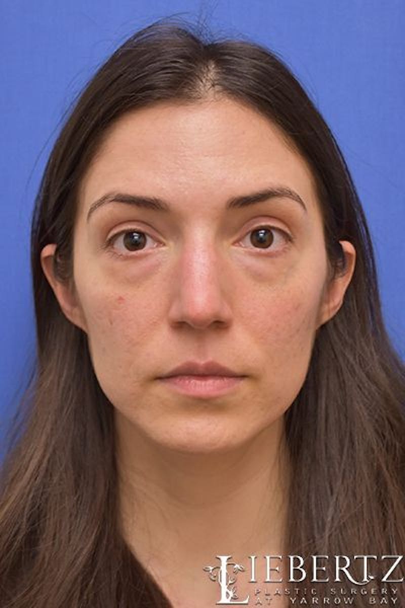 Blepharoplasty Before & After Gallery - Patient 416397 - Image 1