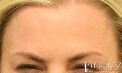 Wrinkle Relaxers Before & After Gallery - Patient 195268 - Image 2