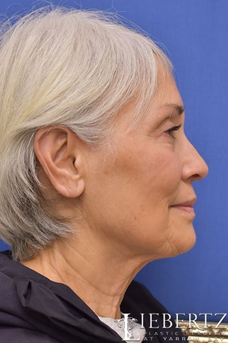 Necklift Before & After Gallery - Patient 263590 - Image 5