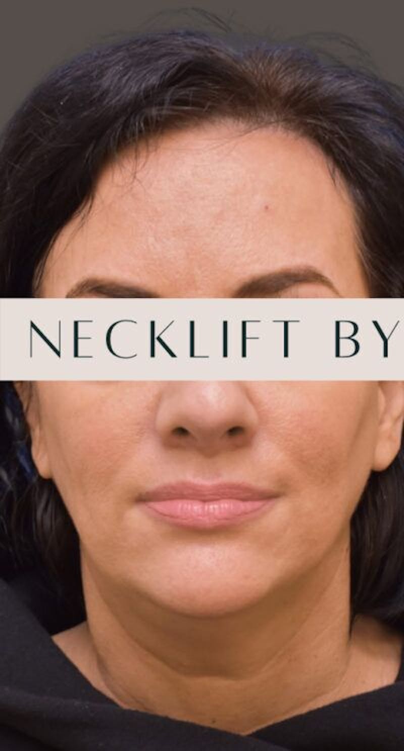 Necklift Before & After Gallery - Patient 302649 - Image 1