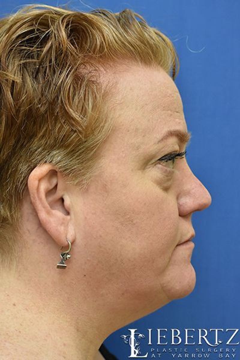 Non-Surgical Lower Blepharoplasty Before & After Gallery - Patient 185610 - Image 3