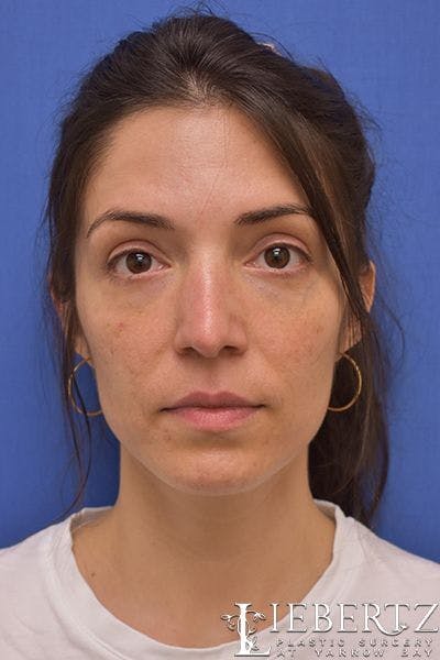 Blepharoplasty Before & After Gallery - Patient 416397 - Image 2