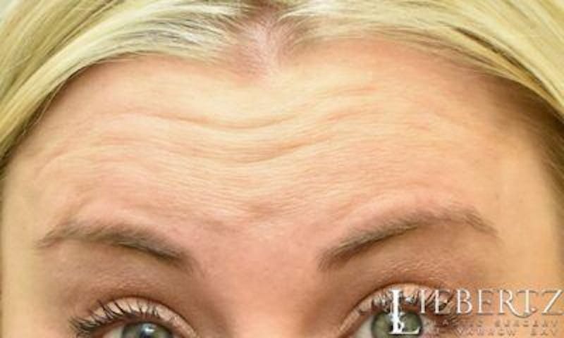 Wrinkle Relaxers Before & After Gallery - Patient 195268 - Image 3