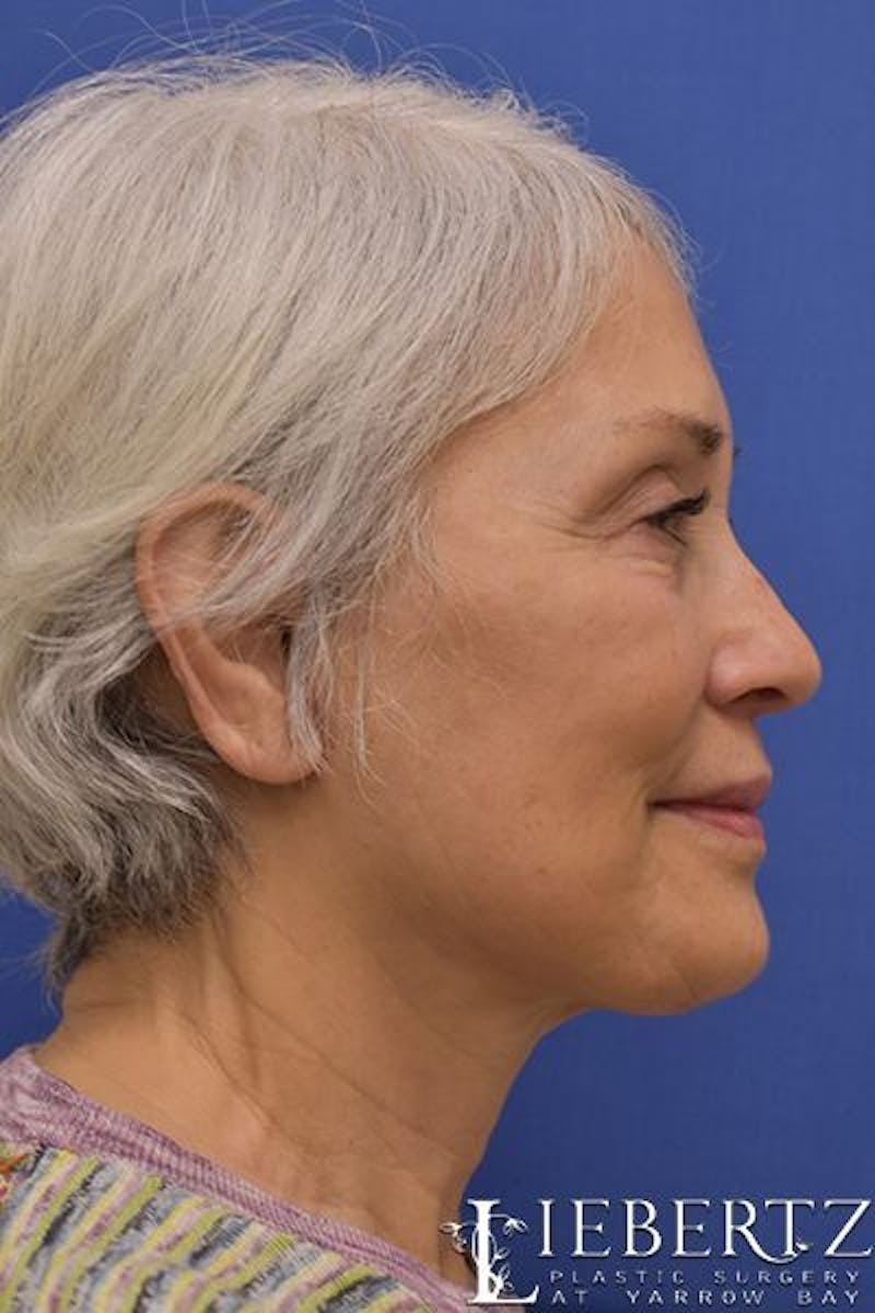 Necklift Before & After Gallery - Patient 263590 - Image 6