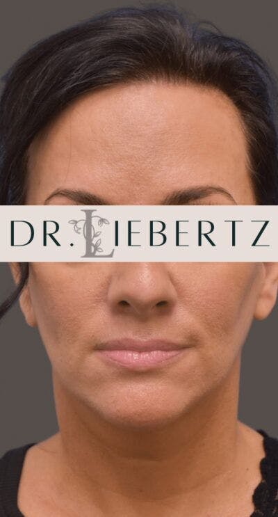 Facelift Before & After Gallery - Patient 166359 - Image 2