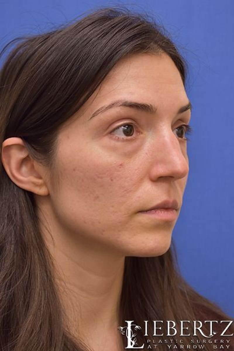 Blepharoplasty Before & After Gallery - Patient 416397 - Image 3