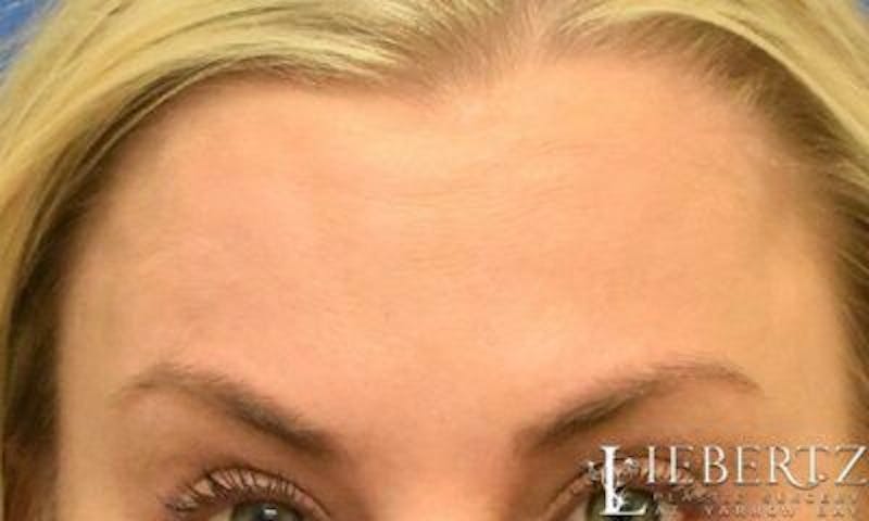 Wrinkle Relaxers Before & After Gallery - Patient 195268 - Image 4
