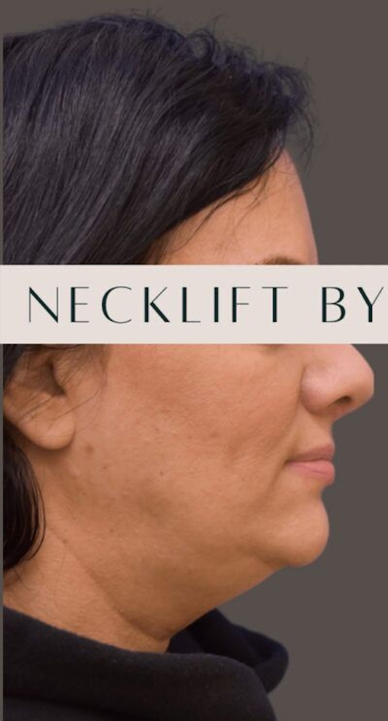 Facelift Before & After Gallery - Patient 166359 - Image 3