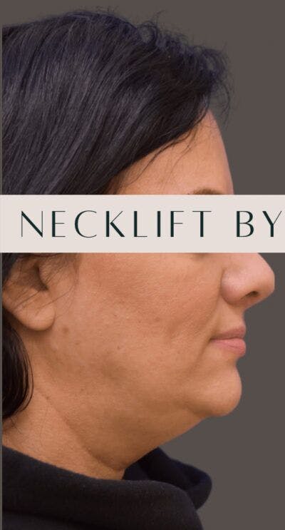 Facelift Before & After Gallery - Patient 166359 - Image 1