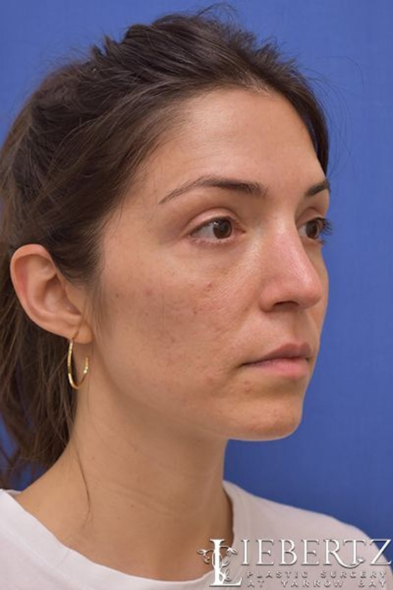 Blepharoplasty Before & After Gallery - Patient 416397 - Image 4
