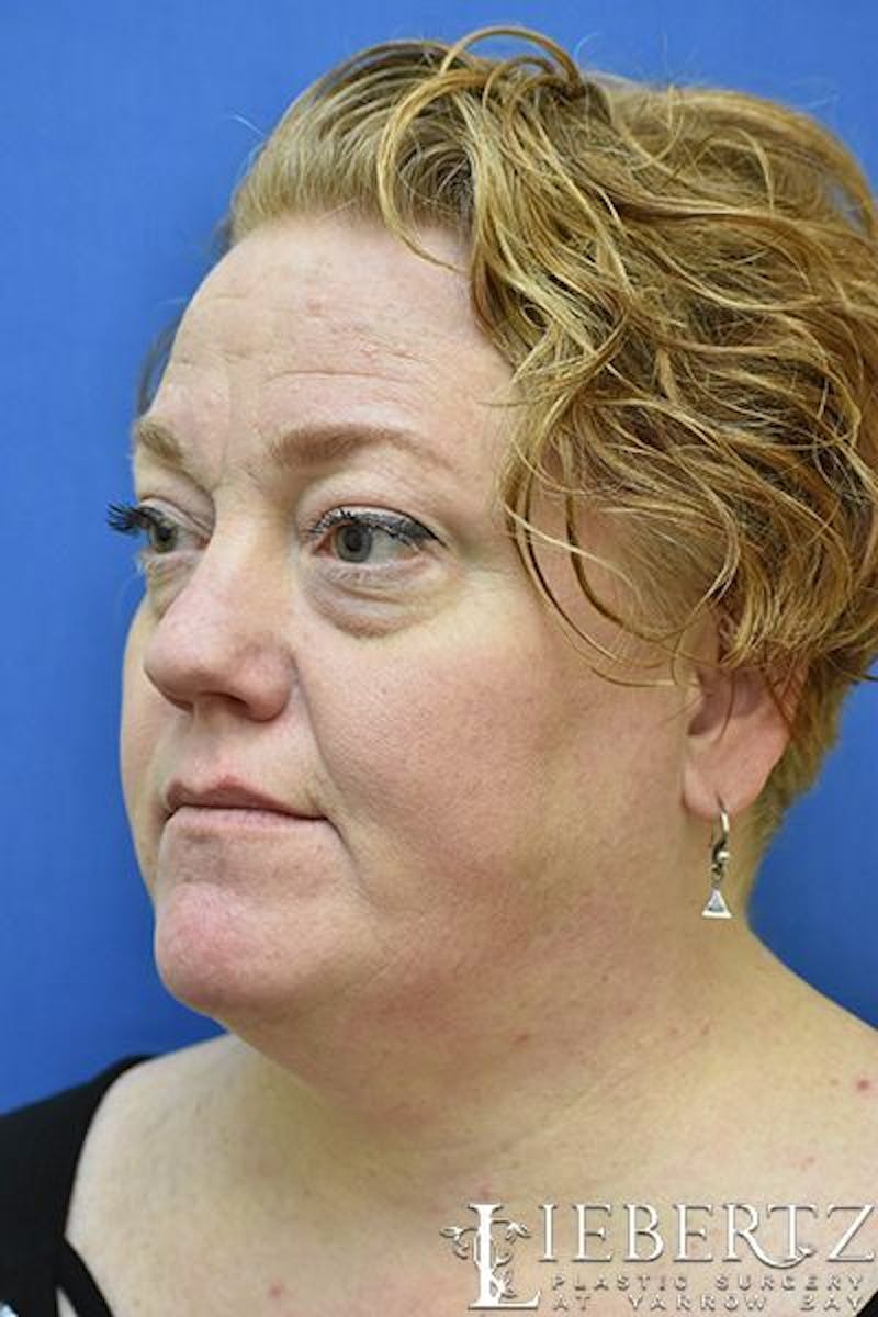Non-Surgical Lower Blepharoplasty Before & After Gallery - Patient 185610 - Image 5