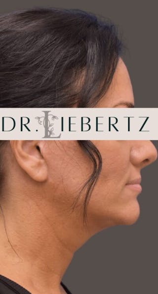 Necklift Before & After Gallery - Patient 302649 - Image 4
