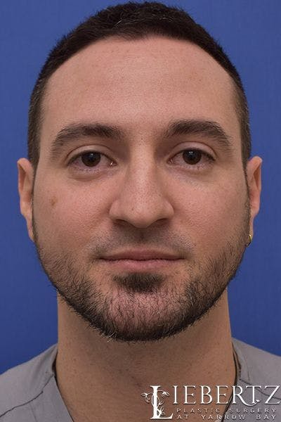 Rhinoplasty Before & After Gallery - Patient 226400 - Image 1