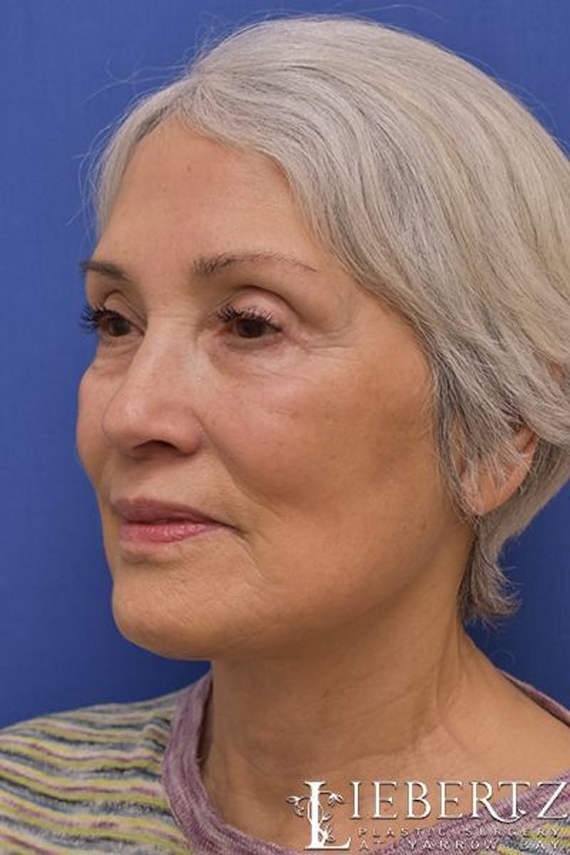 Necklift Before & After Gallery - Patient 263590 - Image 8