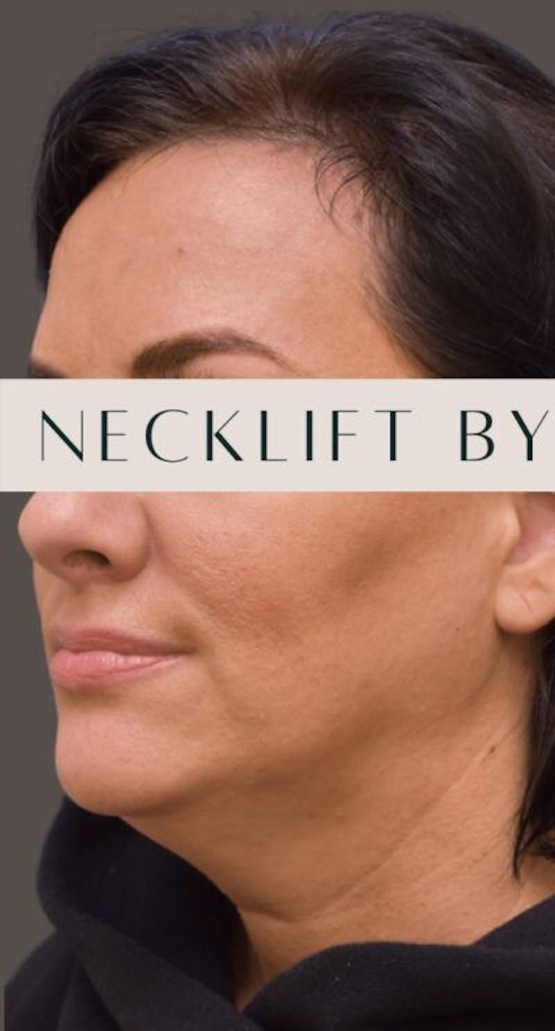 Necklift Before & After Gallery - Patient 302649 - Image 5