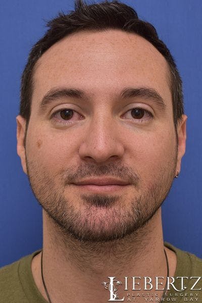 Rhinoplasty Before & After Gallery - Patient 226400 - Image 2