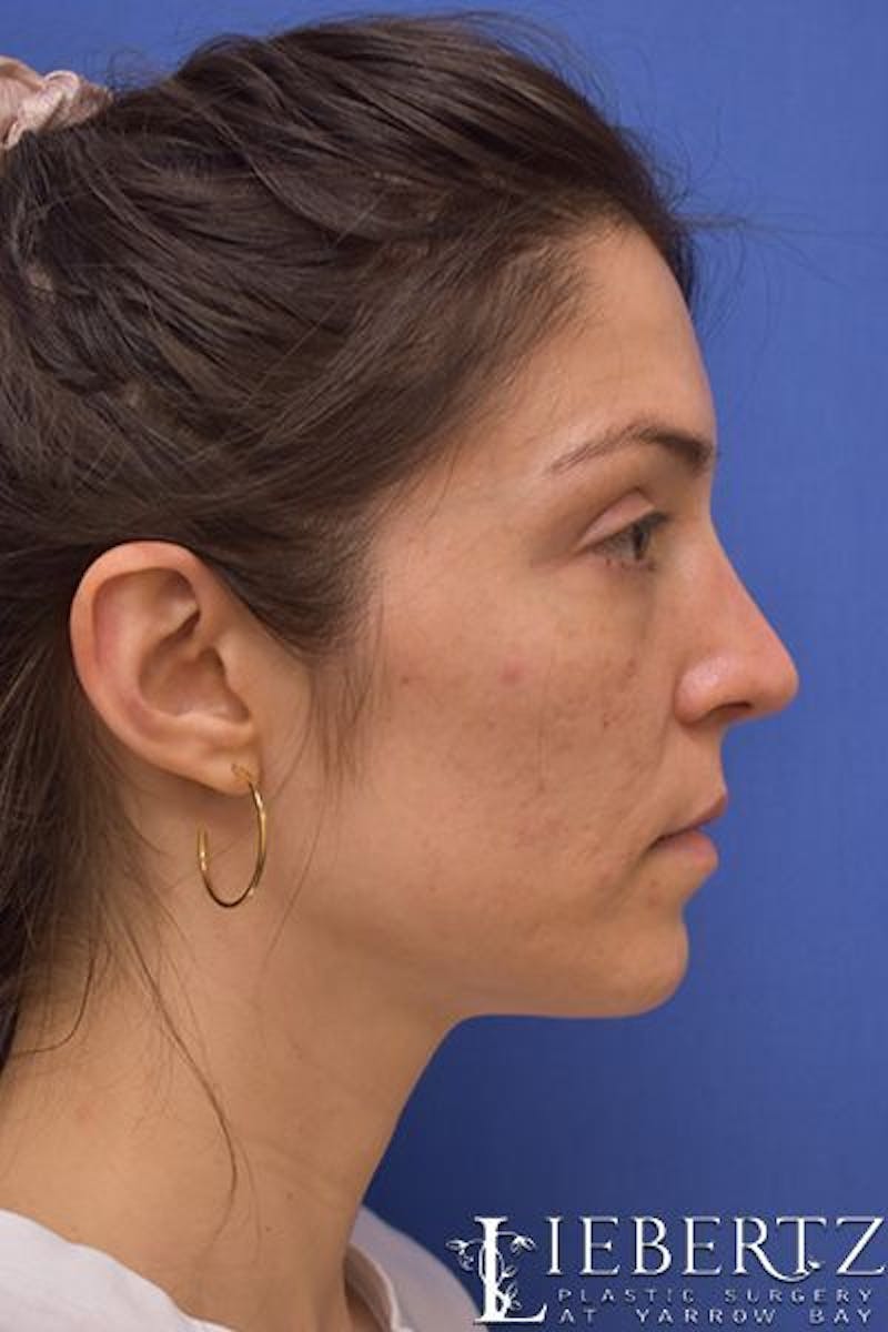 Blepharoplasty Before & After Gallery - Patient 416397 - Image 6