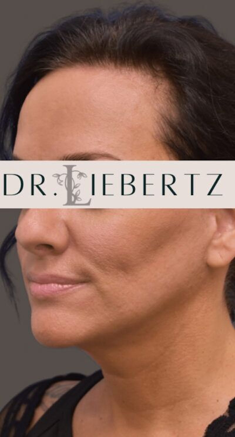 Facelift Before & After Gallery - Patient 166359 - Image 6