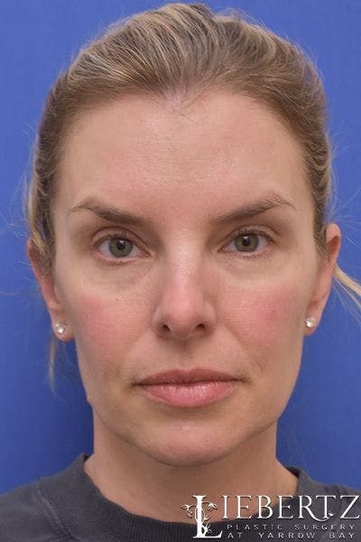 Necklift Before & After Gallery - Patient 139027 - Image 2