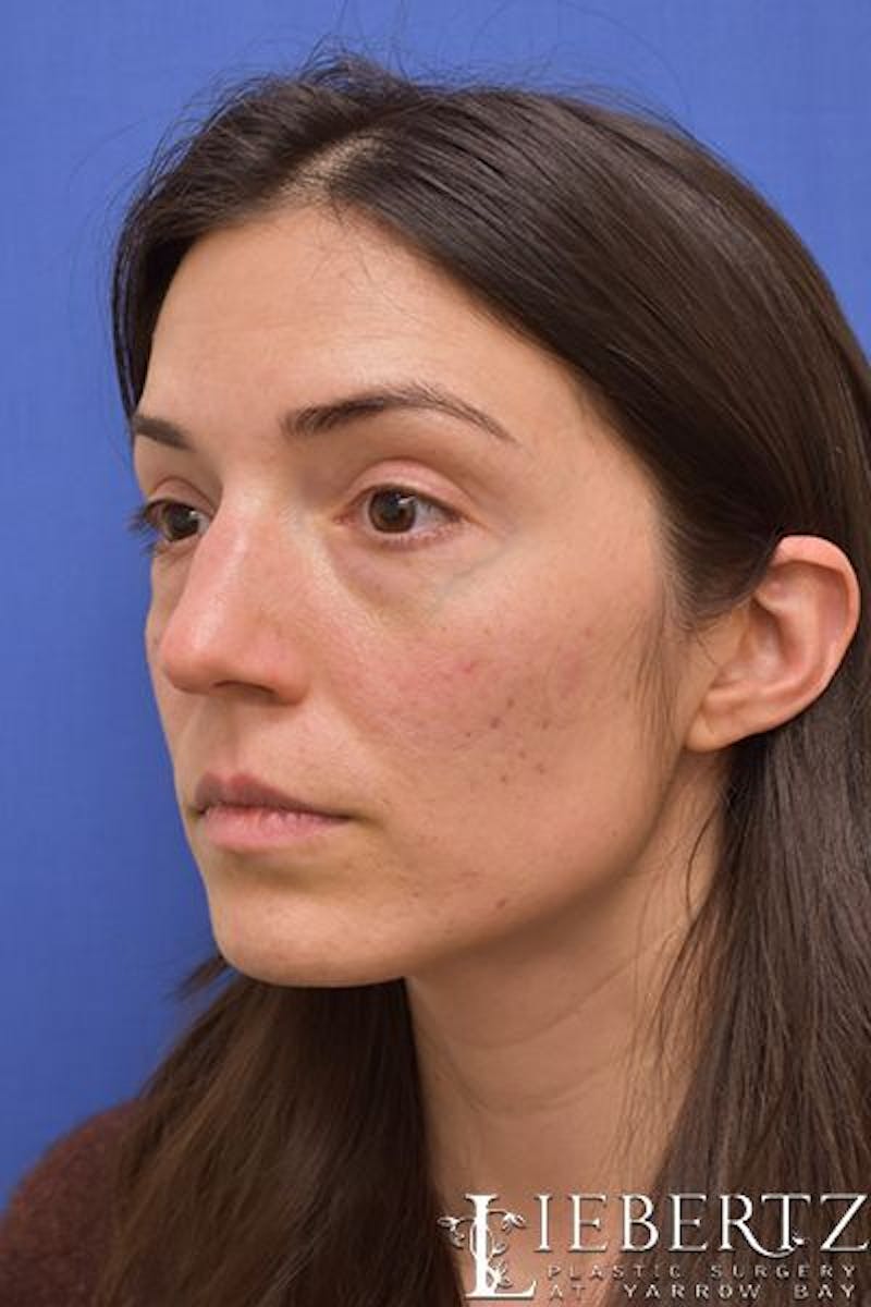 Blepharoplasty Before & After Gallery - Patient 416397 - Image 7