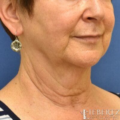 Facelift Before & After Gallery - Patient 332364 - Image 1