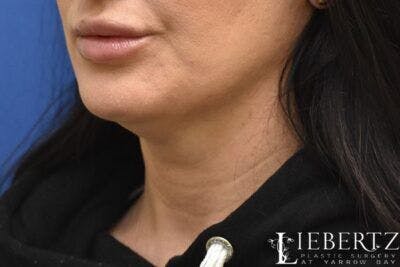 Submental Liposuction Before & After Gallery - Patient 165517 - Image 1