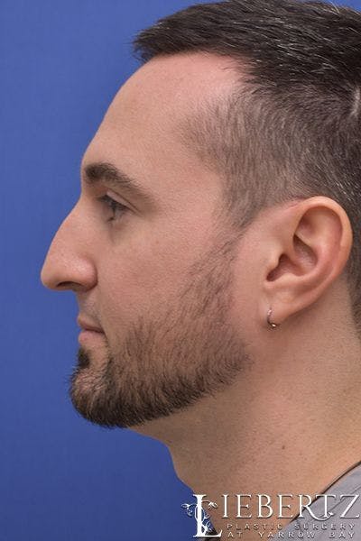 Rhinoplasty Before & After Gallery - Patient 226400 - Image 1