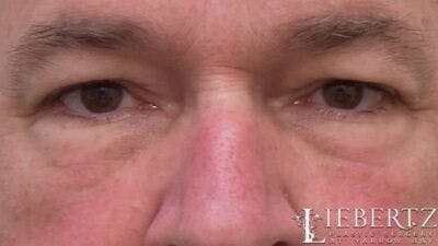 Blepharoplasty Before & After Gallery - Patient 985944 - Image 1