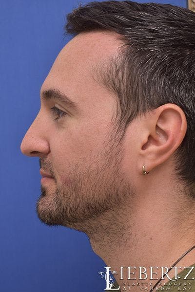 Rhinoplasty Before & After Gallery - Patient 226400 - Image 2