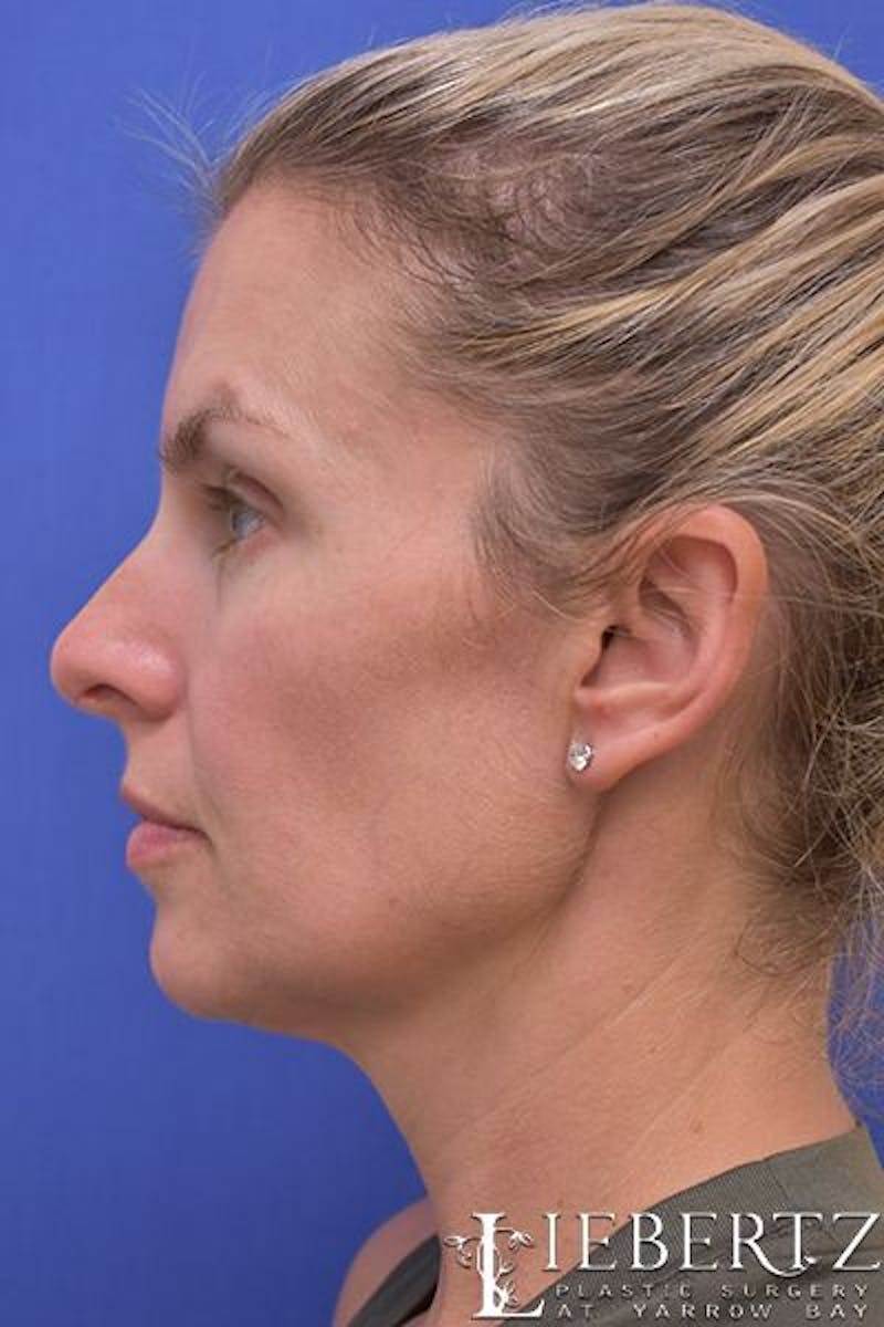 Necklift Before & After Gallery - Patient 139027 - Image 5