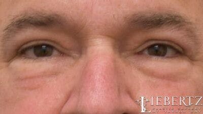 Blepharoplasty Before & After Gallery - Patient 985944 - Image 2