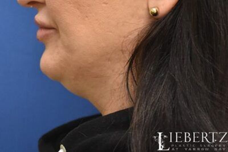 Submental Liposuction Before & After Gallery - Patient 165517 - Image 3