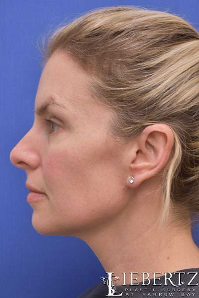 Necklift Before & After Gallery - Patient 139027 - Image 6
