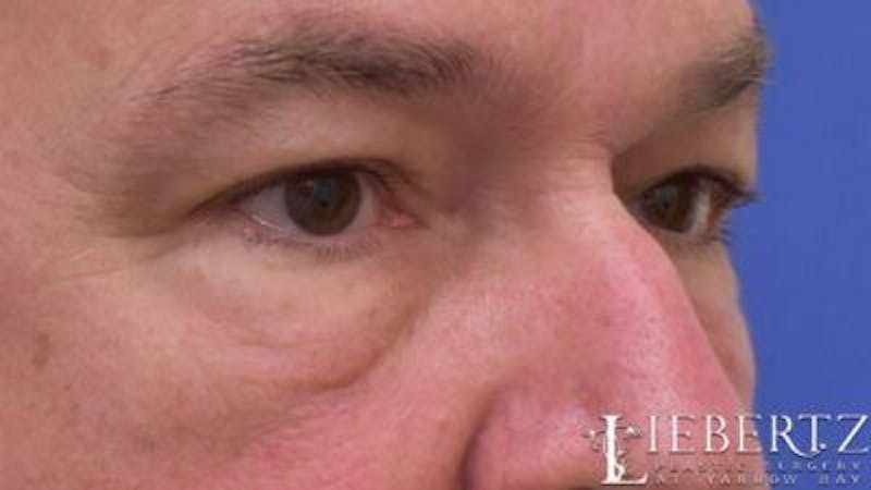 Blepharoplasty Before & After Gallery - Patient 985944 - Image 3
