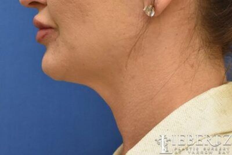 Submental Liposuction Before & After Gallery - Patient 165517 - Image 4