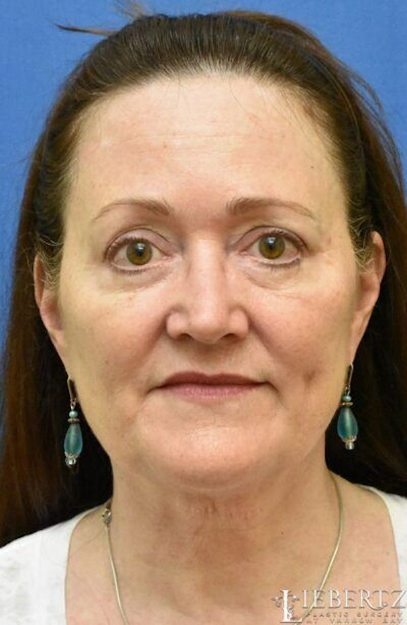 Facelift Before & After Gallery - Patient 196680 - Image 1
