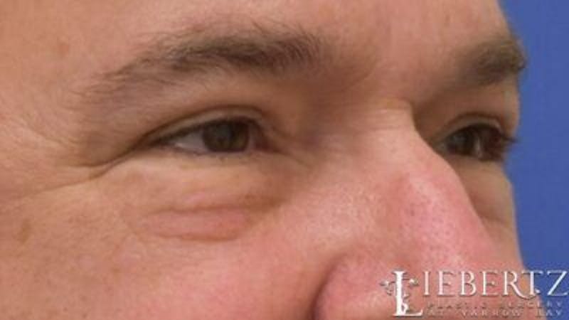 Blepharoplasty Before & After Gallery - Patient 985944 - Image 4